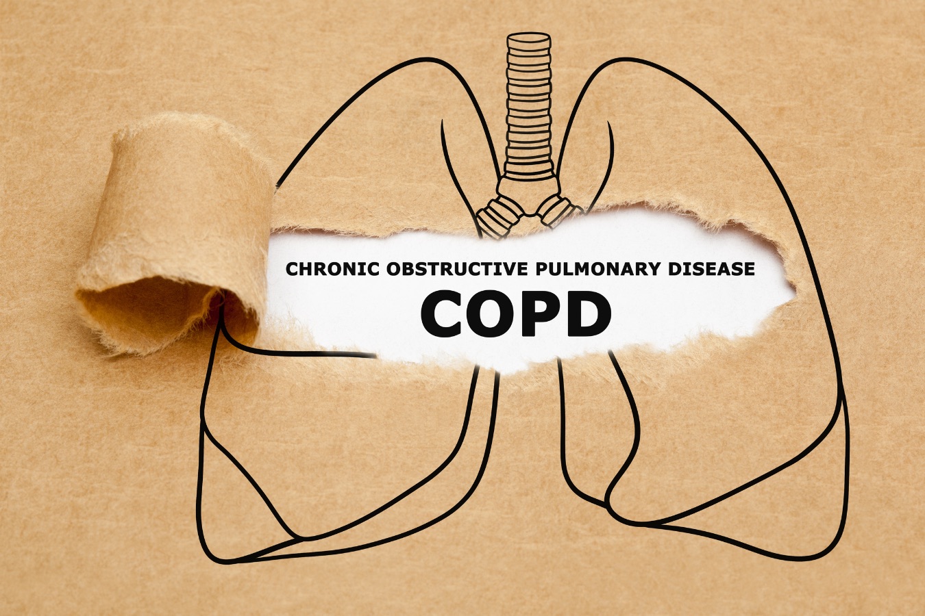 COPD（慢性閉塞性肺疾患）の診断と治療：最新ガイドラインと個別化医療