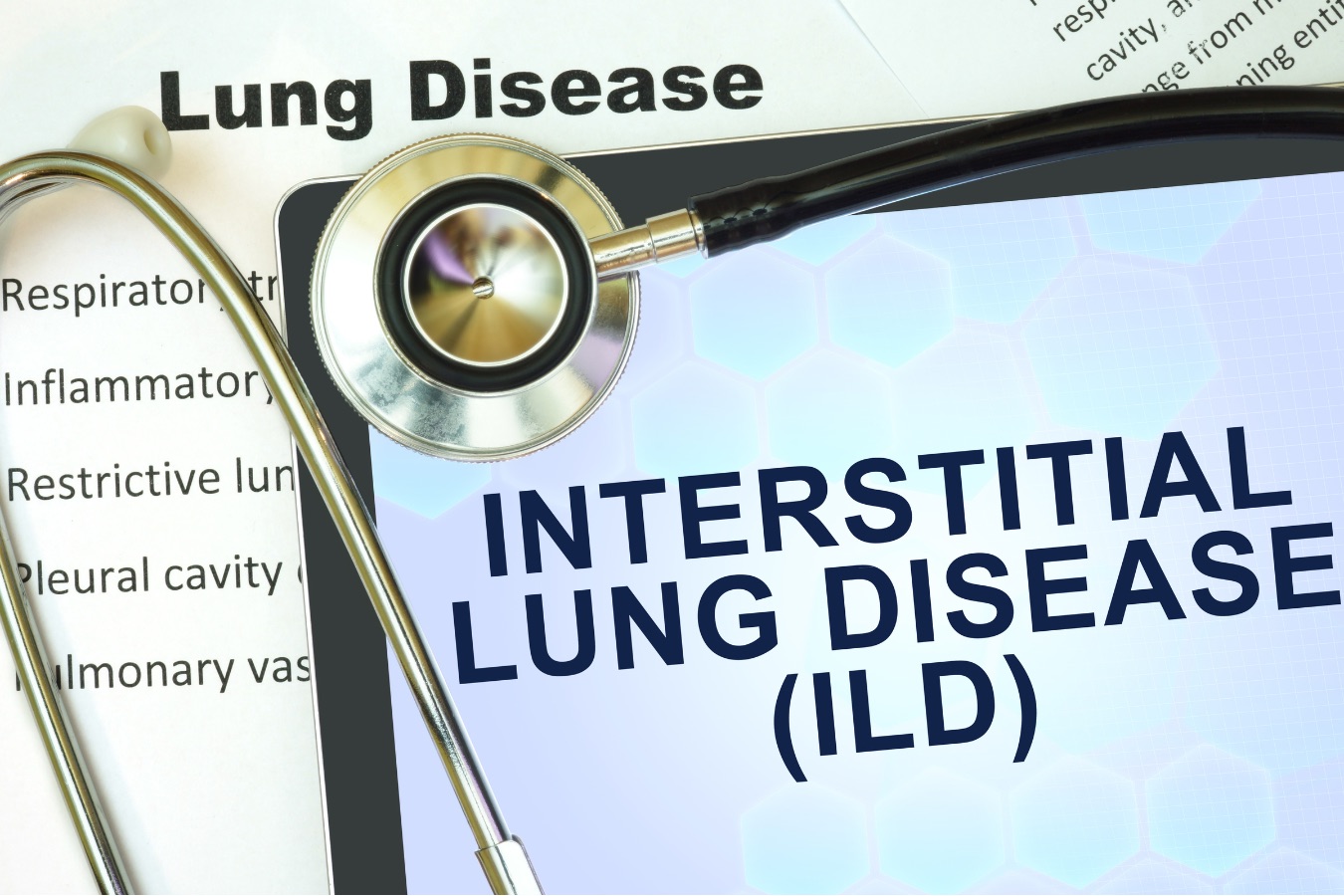 間質性肺疾患（ILD）の診断と治療：線維化抑制と個別化アプローチ